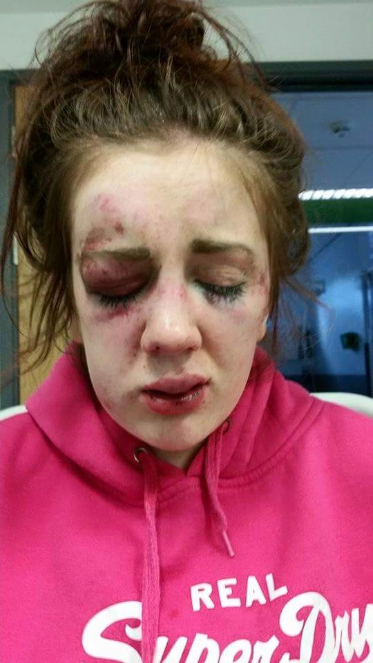 Agressée dans une soirée dansante : Tia Jade Edwards sérieusement défigurée Agressée dans une soirée dansante : Tia Jade Edwards sérieusement défigurée