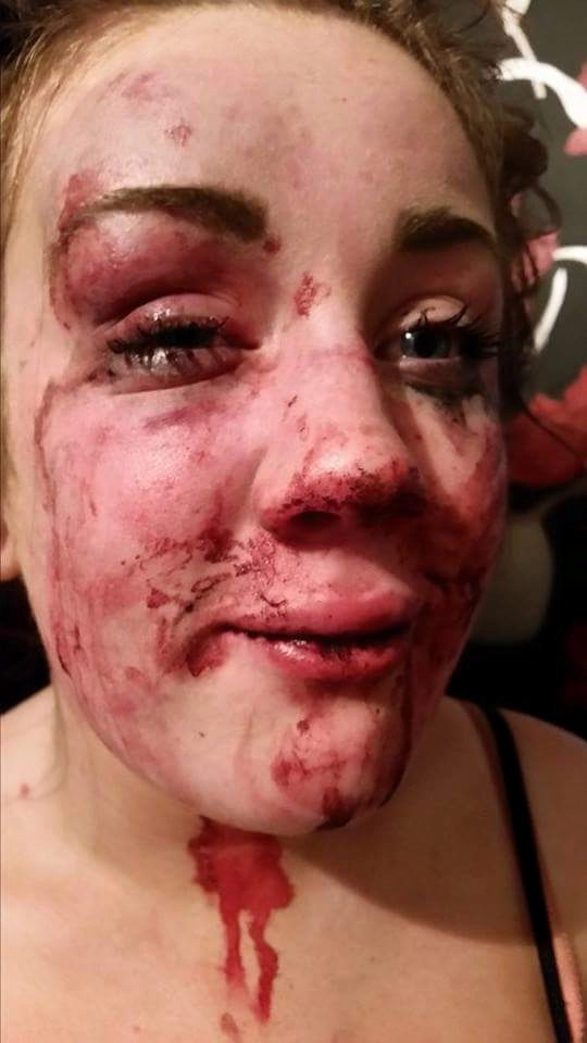 Agressée dans une soirée dansante : Tia Jade Edwards sérieusement défigurée Agressée dans une soirée dansante : Tia Jade Edwards sérieusement défigurée