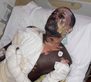 Ébouillanté par sa femme: Babacar Mbaye entre la vie et la mort (images)