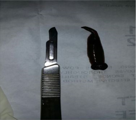 Maroc: une fillette vivait avec une sangsue de 6 centimètres dans la gorge Maroc: une fillette vivait avec une sangsue de 6 centimètres dans la gorge