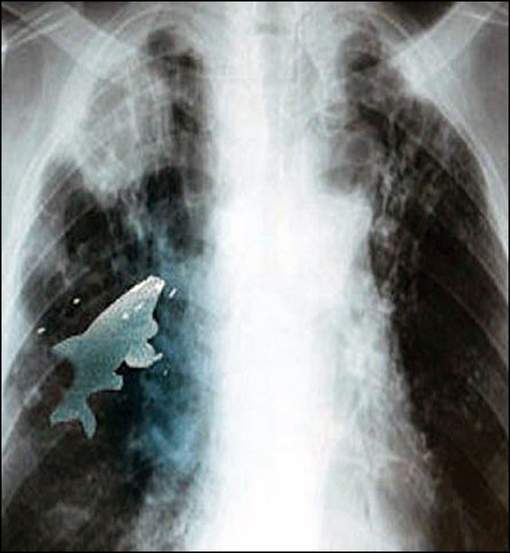Un poisson vivant dans les poumons d'un enfant Un poisson vivant dans les poumons d'un enfant