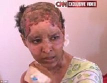 Trois mois ferme à la femme qui avait ébouillanté sa ‘’co-épouse’’ Trois mois ferme à la femme qui avait ébouillanté sa ‘’co-épouse’’