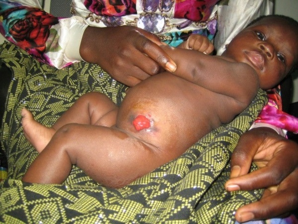 Bébé Adama enfin opéré: L'Association Ndimbel Jaboot aide familiale vous remercie Bébé Adama enfin opéré: L'Association Ndimbel Jaboot aide familiale vous remercie