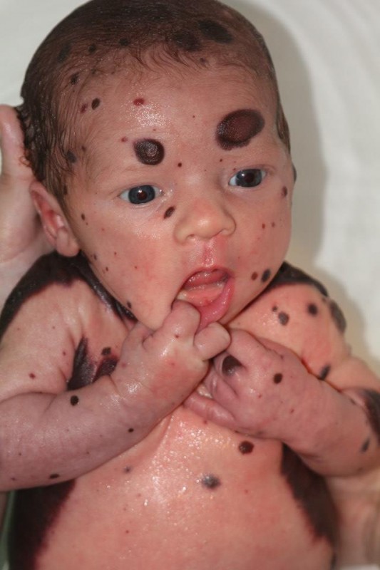 Un bébé avec une maladie de peau se fait poser des implants