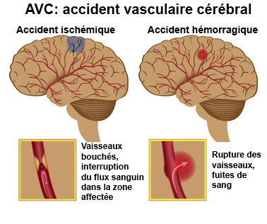 Voici comment sauver une personne d’un AVC en utilisant juste une Aiguille