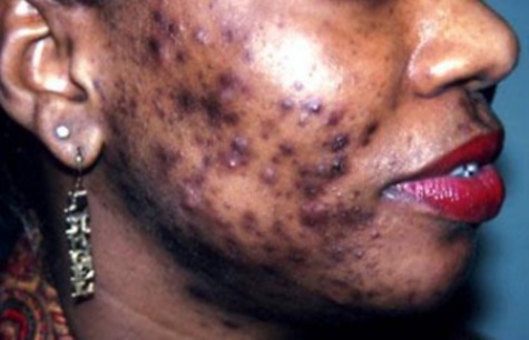 La dépigmentation « Xessal » coûte 5 milliards de CFA aux ménages sénégalais