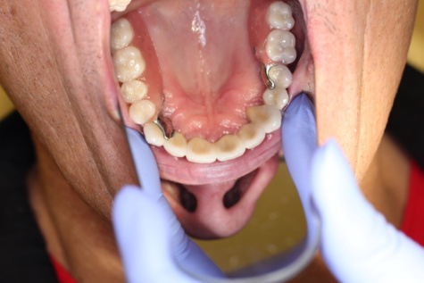 Dentier