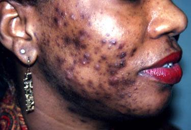 La dépigmentation, une mode chez les femmes sénéglaises