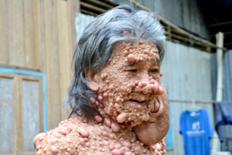 Insolite : (Ames sensibles s'abstenir) : Atteint d'une tumeur bizarre, Shiti Charoenrattanaprapa, âgé de 60 ans, vit seul depuis 45 ans