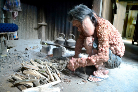 Insolite : (Ames sensibles s'abstenir) : Atteint d'une tumeur bizarre, Shiti Charoenrattanaprapa, âgé de 60 ans, vit seul depuis 45 ans