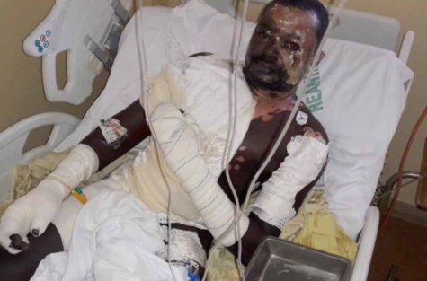 Ébouillanté par sa femme: Babacar Mbaye entre la vie et la mort (images)