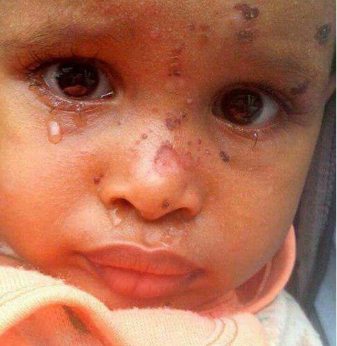 Photos - Maladies de peau et tumeurs malignes se propagent chez les Yéménites à Saada à cause des bombes saoudiennes  