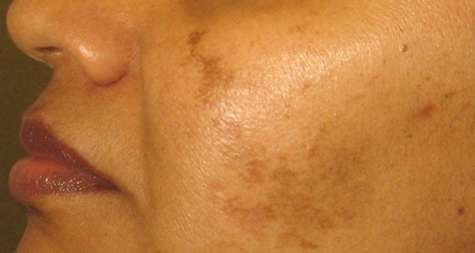 Débarrassez-vous des taches brunes et de l’hyperpigmentation avec deux ingrédients