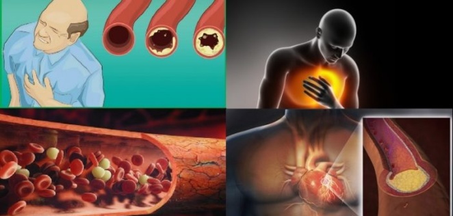 Santé: attention! Voici ce qui bouche les artères et cause la mort