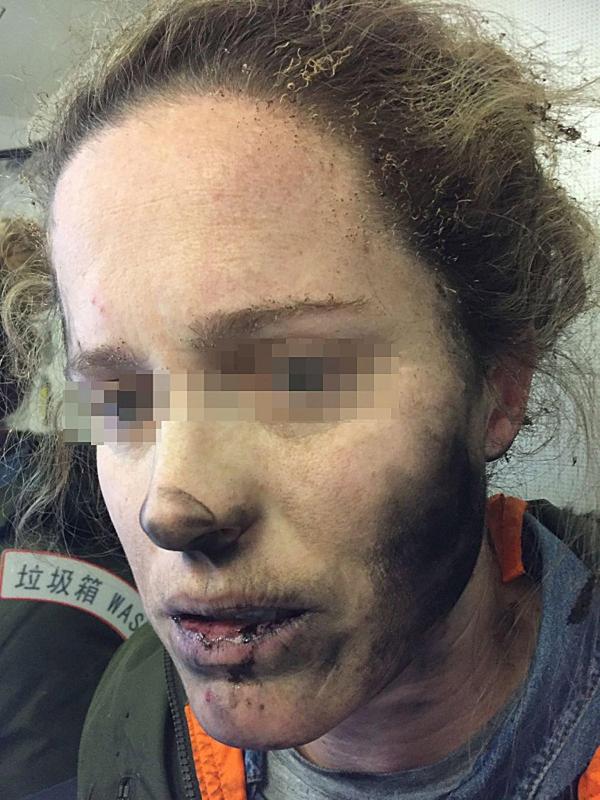 Ses écouteurs explosent à son visage en plein vol alors qu'elle écoute de la musique: elle a des brûlures un peu partout sur le corps (photos)