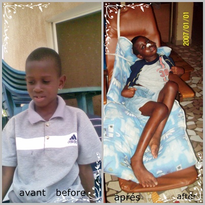 [SOS] PAPA IDRISSA NDIAYE est un jumeau de 9ans. Il a été victime d’un accident de la circulation. Après un mois de coma, il se retrouve en semi coma, il est devenu paraplégique. Aidons ce garçon !
