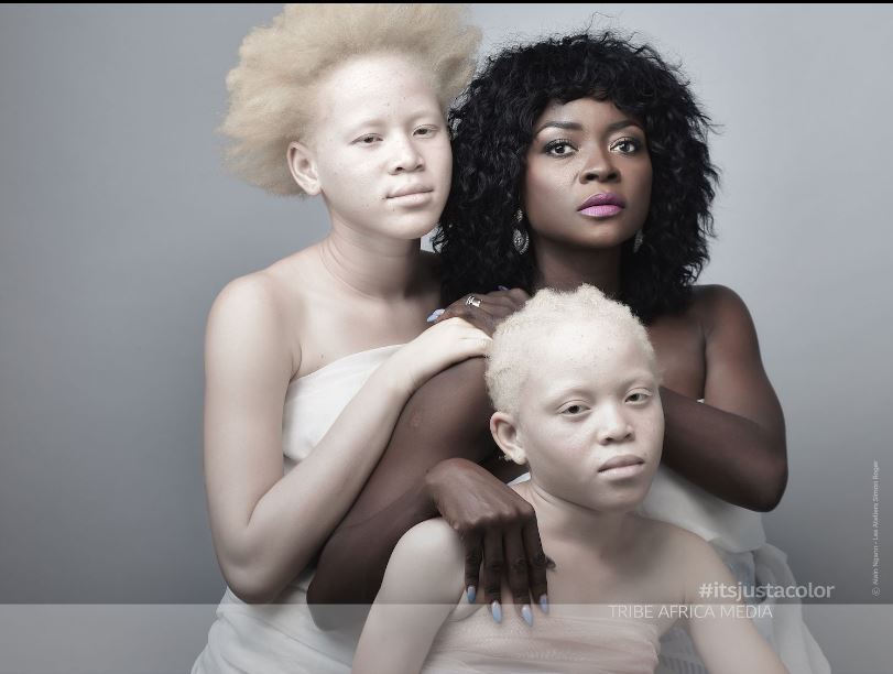 Journée Internationale de sensibilisation à l'albinisme