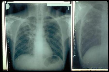 PROPAGATION DE LA TUBERCULOSE  L’ampleur devient inquiétante dans les banlieues