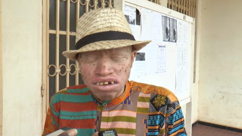 ​Ziguinchor : A quelques jours des élections législatives, les albinos réclament la protection de l’Etat