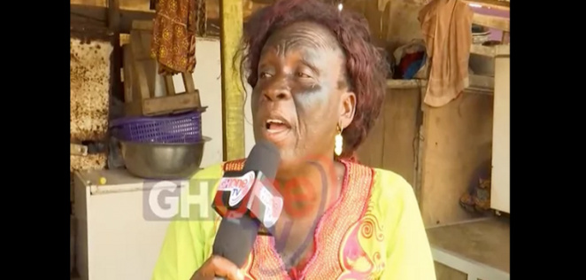 Ghana: Elle perd la vue dans ses tentatives de se blanchir la peau