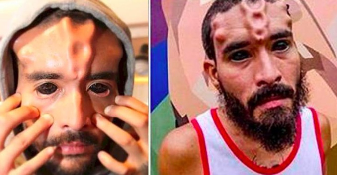 Un homme qui rêve de ressembler à un démon se fait couper le nez, mais c'est loin d'être le plus troublant qu'il a fait !