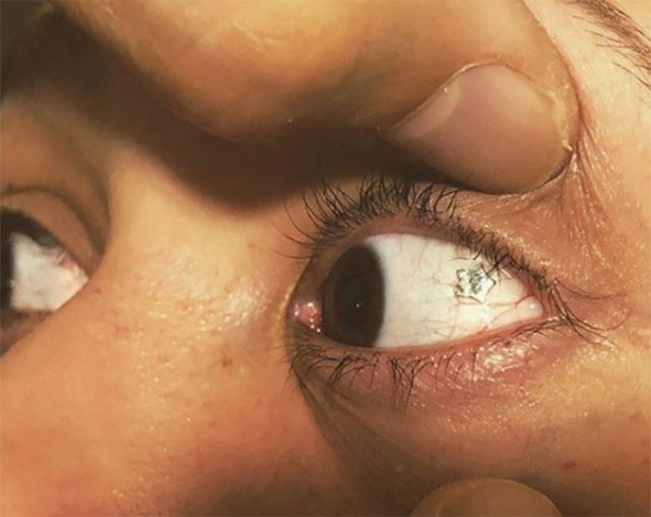 A New York, des femmes s’implantent des bijoux dans les globes oculaires