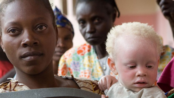 Afrique: «Les albinos sont considérés comme des êtres dotés de pouvoirs»