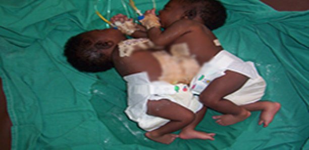 Urgent: Décès d’une des soeurs siamoises séparées à l’hôpital Fann Urgent: Décès d’une des soeurs siamoises séparées à l’hôpital Fann