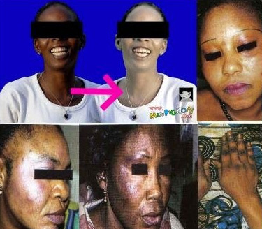 La dépigmentation a la peau dure