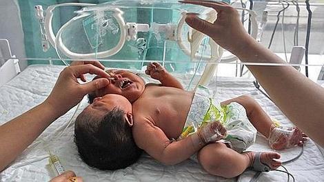 Un bébé chinois naît avec deux têtes