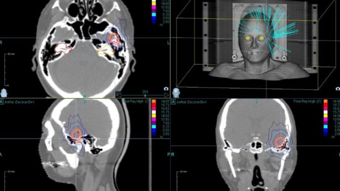 VIDEO - CHU de Bordeaux: un robot révolutionnaire pour soigner le cancer