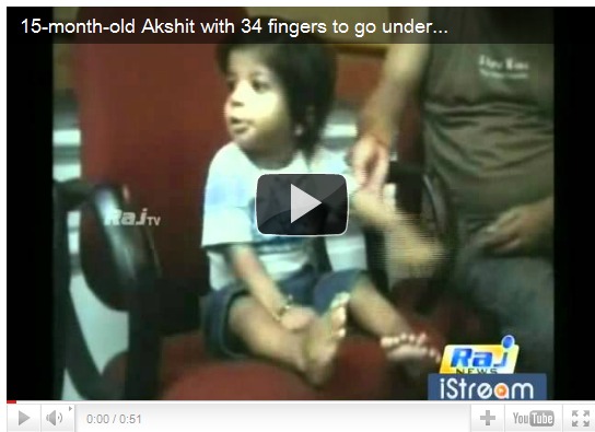 Un petit indien est né avec 34 doigts (vidéo)