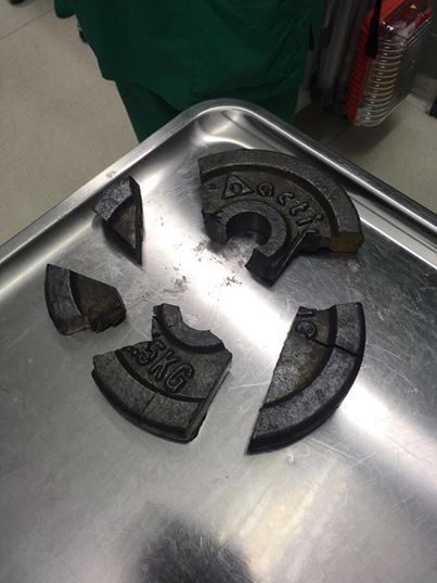 Il se coince le p*nis dans un haltère et se retrouve aux urgences Il se coince le p*nis dans un haltère et se retrouve aux urgences