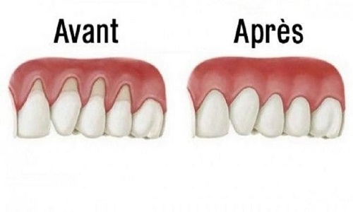 Les 7 remèdes naturels les plus efficaces contre les gencives qui se rétractent