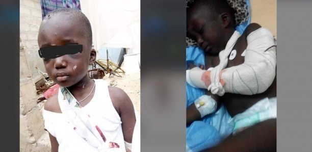 Mbour: L‘enfant torturé par sa belle-mère raconte son calvaire