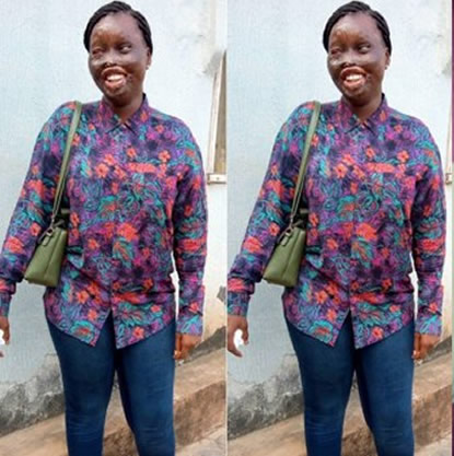 Défigurée à l’acide par l’épouse de son oncle, elle raconte son histoire Défigurée à l’acide par l’épouse de son oncle, elle raconte son histoire