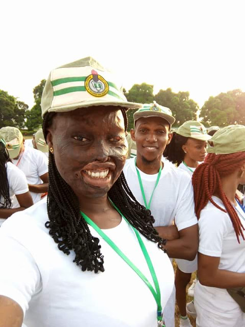 Défigurée à l’acide par l’épouse de son oncle, elle raconte son histoire Défigurée à l’acide par l’épouse de son oncle, elle raconte son histoire