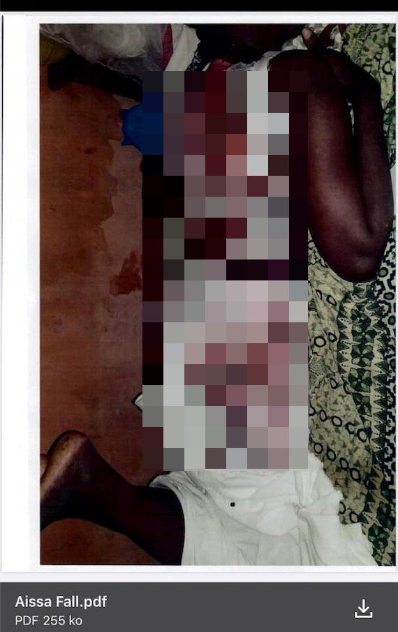 Aïssa Fall, victime de brûlures: "Mon cœur peut lâcher à tout moment" Aïssa Fall, victime de brûlures: "Mon cœur peut lâcher à tout moment"