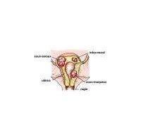 Ultrasons : nouveau traitement des fibromes utérins