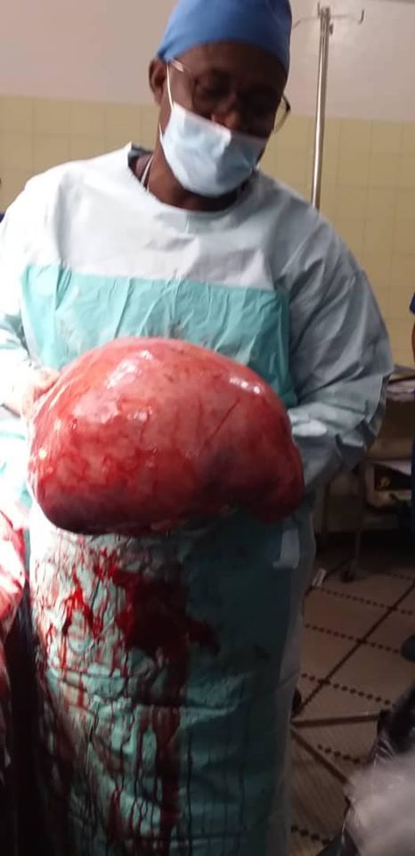 Photos: fibrome de dix kilogrammes retiré d'une dame à Thiès