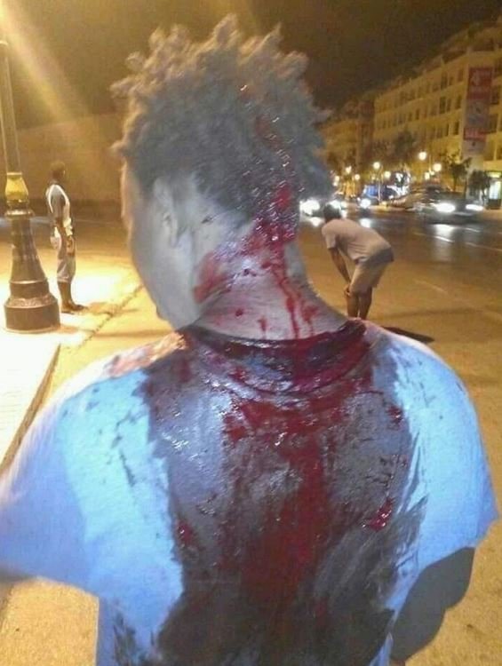 Maroc: Un étudiant guinéen violemment agressé Maroc: Un étudiant guinéen violemment agressé