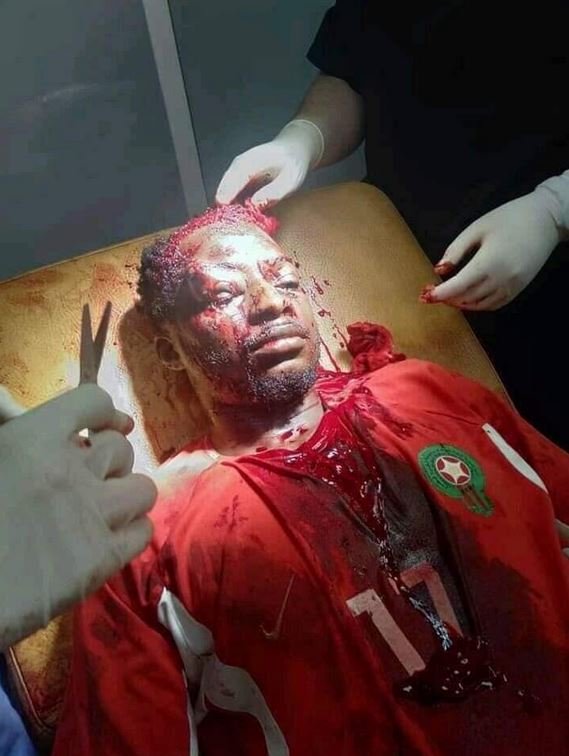 Maroc: Un étudiant guinéen violemment agressé Maroc: Un étudiant guinéen violemment agressé