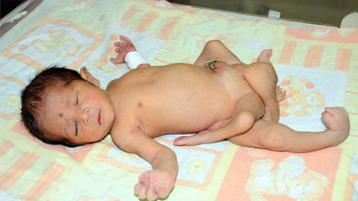 Un bébé né avec six jambes