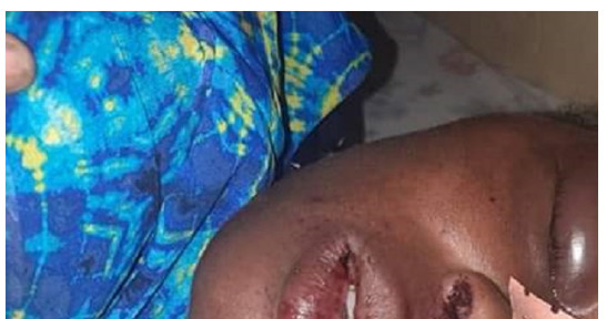 Guédiawaye: Ivre mort, un homme défigure le visage de sa femme (photo) Guédiawaye: Ivre mort, un homme défigure le visage de sa femme (photo)