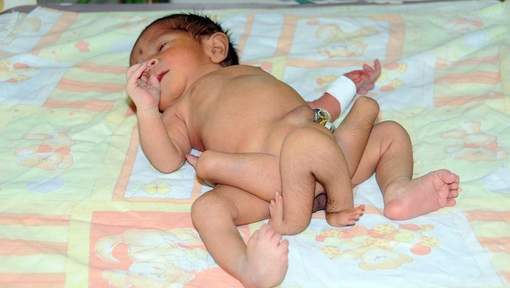Le bébé né avec six jambes opéré avec succès