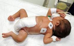 Le bébé né avec six jambes opéré avec succès