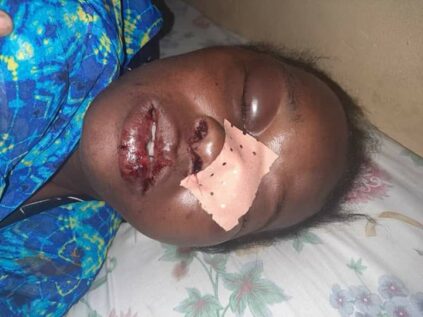 Guédiawaye: Un homme recherché pour avoir défiguré le visage de sa femme 