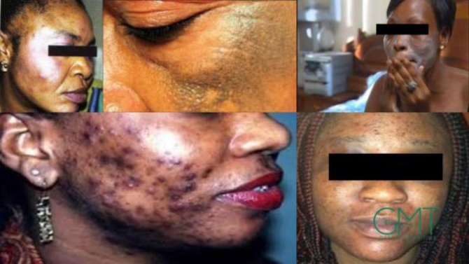 Dépigmentation: Au-delà d’une simple interdiction de la publicité