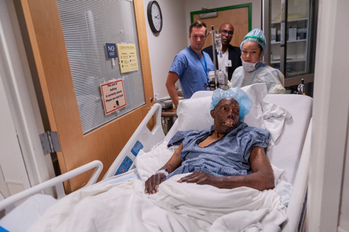 Après 18 interventions chirurgicales, il devient le premier Afro-Américain à recevoir une greffe au visage Après 18 interventions chirurgicales, il devient le premier Afro-Américain à recevoir une greffe au visage