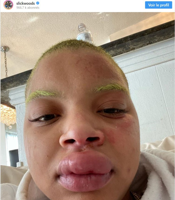 La mannequin préférée de Rihanna…défigurée (Photo)